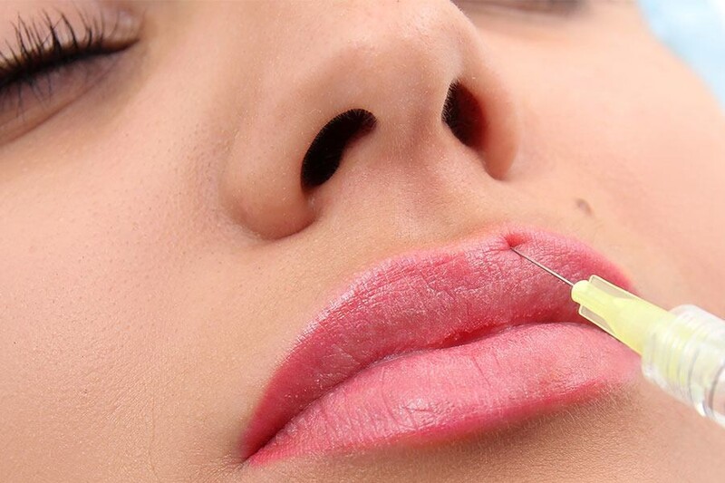 Tiêm filler môi thường cần từ 3 đến 7 ngày để giảm sưng, ổn định dáng và vào form tự nhiên hơn. 