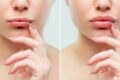Chăm sóc môi đúng cách sau tiêm giúp filler ổn định nhanh, hạn chế xê dịch và duy trì dáng môi đẹp lâu hơn. 