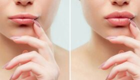 Chăm sóc môi đúng cách sau tiêm giúp filler ổn định nhanh, hạn chế xê dịch và duy trì dáng môi đẹp lâu hơn. 