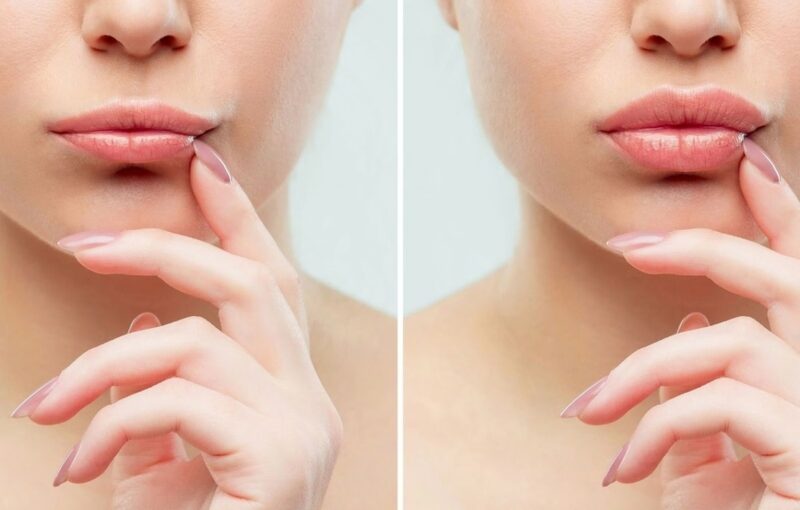 Chăm sóc môi đúng cách sau tiêm giúp filler ổn định nhanh, hạn chế xê dịch và duy trì dáng môi đẹp lâu hơn. 