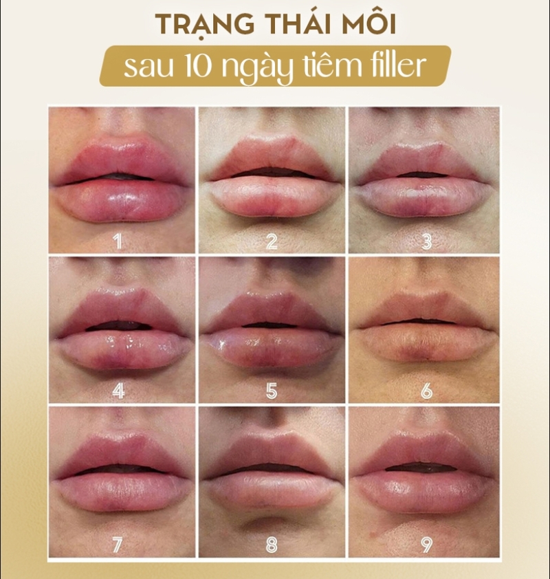 Môi sau tiêm filler sẽ trải qua quá trình sưng nhẹ, giảm căng, mềm dần và ổn định dáng theo từng ngày. 